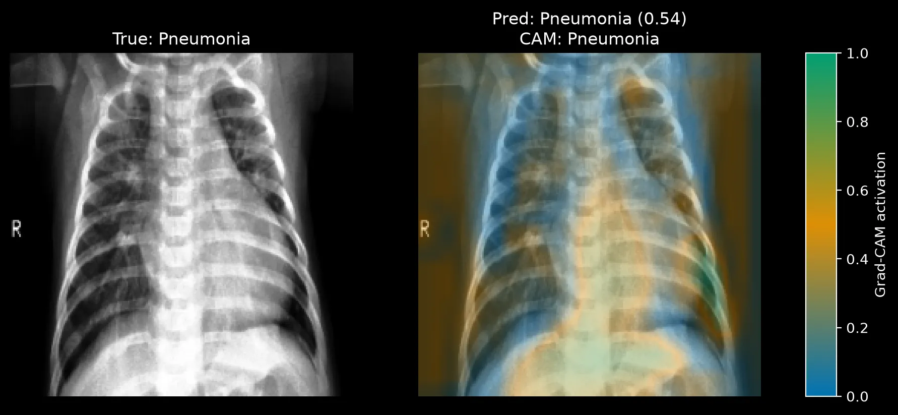 Grad-CAM for a Pneumonia image predicted Pneumonia at 0.54, with diffuse activation over the central chest, lower thorax, and side margins.