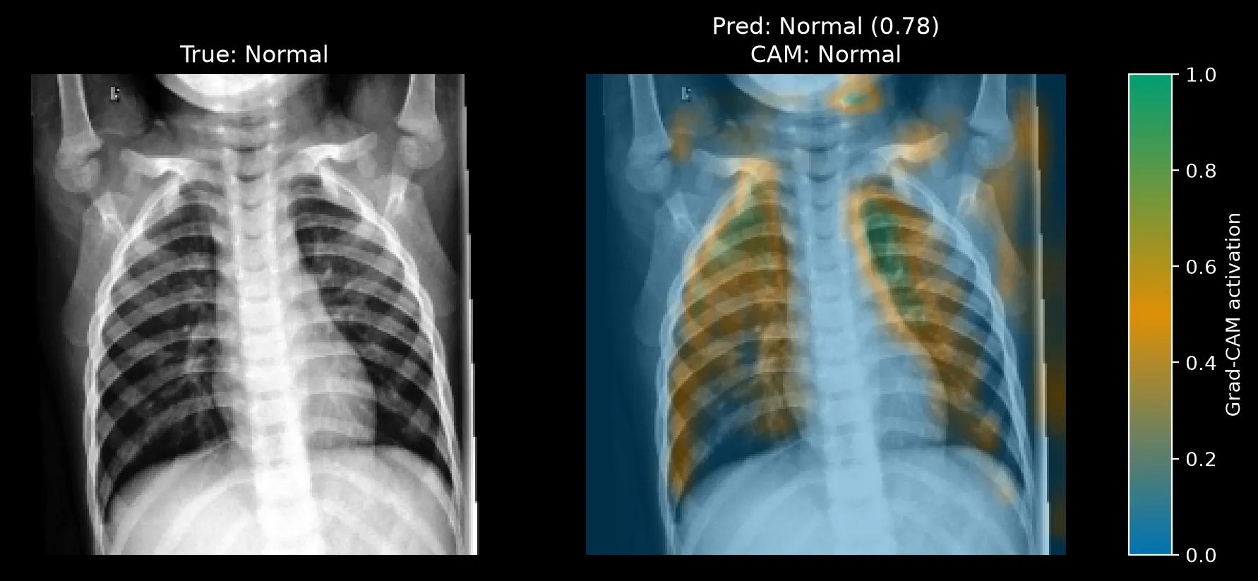 Grad-CAM for a Normal image predicted Normal at 0.78, with activation along the upper lung fields and rib edges.