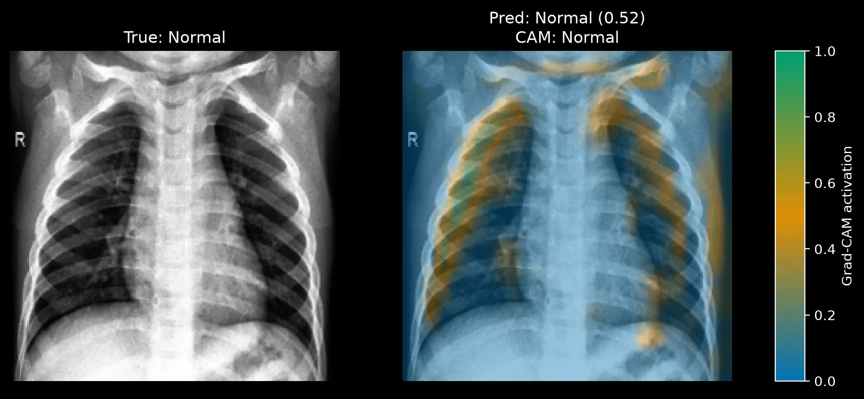 Grad-CAM for a Normal image predicted Normal at 0.52, with thin activation along rib edges and small patches at the shoulders.