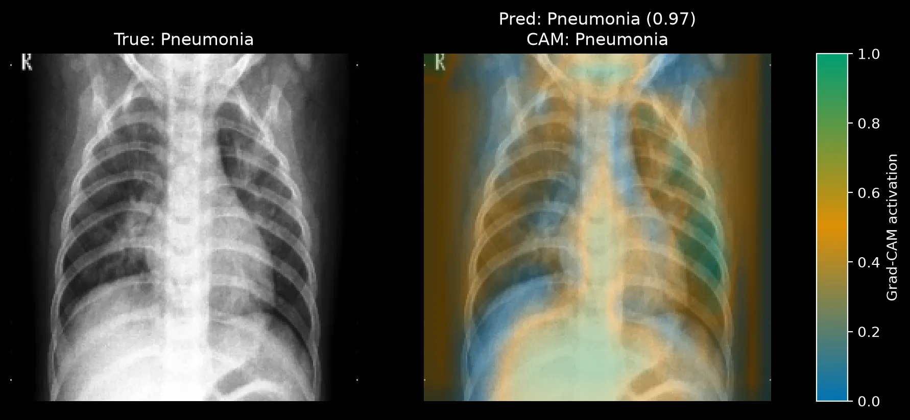 Grad-CAM for a Pneumonia image predicted Pneumonia at 0.97, with strong activation across the lower chest and abdomen and along the left and right frame margins.