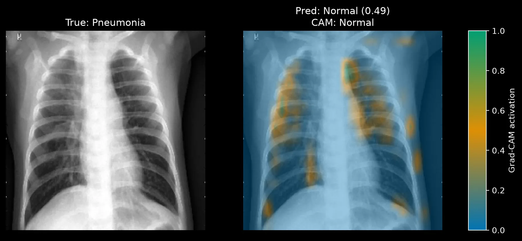 Grad-CAM for a true Pneumonia image predicted Normal at 0.49, with scattered small patches of activation across both lung fields and a few spots near the lung margins.