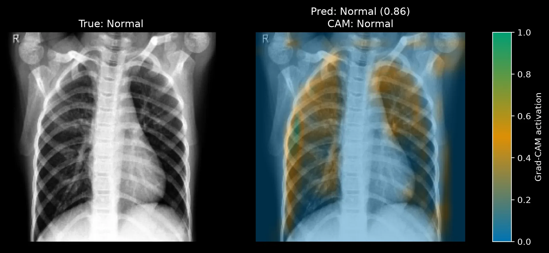 Grad-CAM for a Normal image predicted Normal at 0.86, with orange and green activation inside both lung fields.